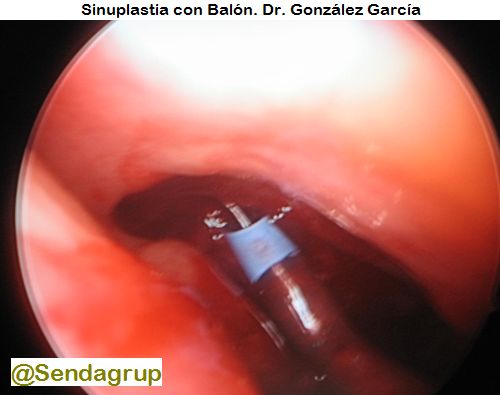 sinuplastia_con_balon_dr-gonzalez-1