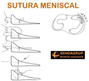 sutura_meniscal_sendagrup