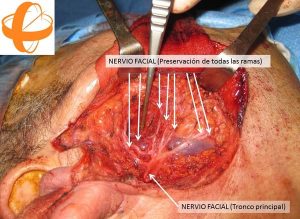 Foto 2 del texto del Dr. González: Refinamientos estéticos y funcionales en la cirugía de la glándula parótida. Centro Médico Sendagrup Donostia - San Sebastián. @Sendagrup @ORLZuatzu