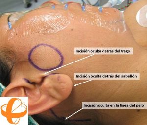 Foto 3 del texto del Dr. González: Refinamientos estéticos y funcionales en la cirugía de la glándula parótida. Centro Médico Sendagrup Donostia - San Sebastián. @Sendagrup @ORLZuatzu