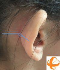 Se pueden tratar orejas despegadas sin cirugía?