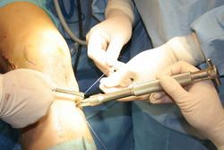Imagen de cirugía reconstructiva de la rotura del ligamento cruzado anterior (LCA) por artroscopia 