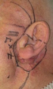 orl otorrinolaringologia cancer de laringe dr gonzalez cirugia reconstructiva cabeza cuello sendagrup donostia Utilidad y versatilidad del colgajo en isla de la arteria supraclavicular en reconstrucción de cabeza y cuello