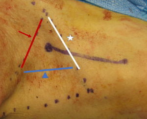 Utilidad y versatilidad del colgajo en isla de la arteria supraclavicular en reconstrucción de cabeza y cuello