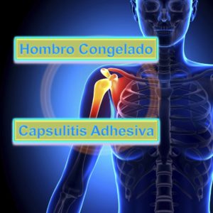 Capsulitis Adhesiva de Hombro u Hombro Congelado, patología musculoesquelética más frecuente en personas con diabetes