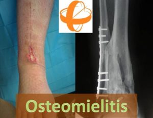 Osteomielitis o Infección ósea, secundaria a una fractura abierta con cirugía reconstructiva con material de osteosíntesis