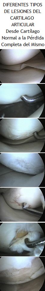 Diferentes tipos de lesiones del cartílago articular de la rodilla. Ponencia del Dr. Usabiaga en la Jornada Monográfica de Rodilla 2018 organizada por el Foro Sendagrup