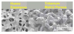 Tritanium, matriz de material poroso que evita la necesidad de utilizar cemento biológico en la prótesis de rodilla. Dr. Mikel Zaldúa del Centro Médico Sendagrup de Donostia - San Sebastián