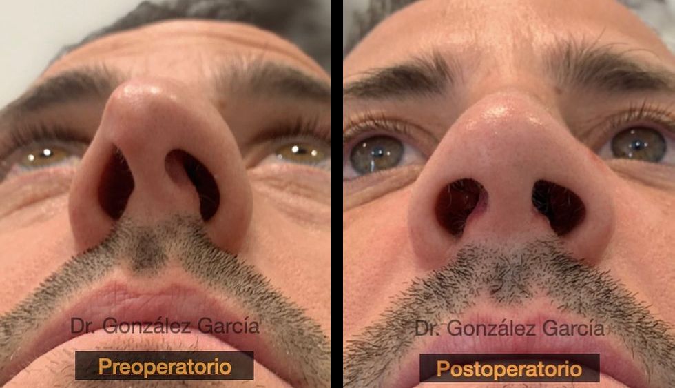 Rinoplastia ultrasónica funcional y estética por el Dr. González del Centro Médico Sendagrup de Donostia - San Sebastián