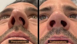 Rinoplastia funcional y estética por el Dr. González del Centro Médico Sendagrup de Donostia - San Sebastián