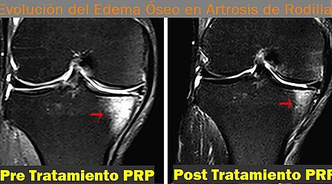 Evolución del edema óseo en la artrosis de rodilla con el tratamiento de plasma tico en plaquetas (PRP)