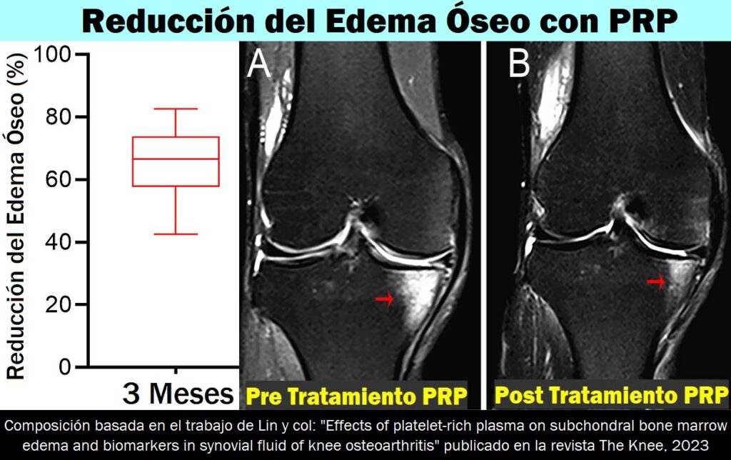 Disminución del edema óseo ligado a la artrosis de rodilla, tras tratamiento con factores de crecimiento (Plasma Rico en Plaquetas)