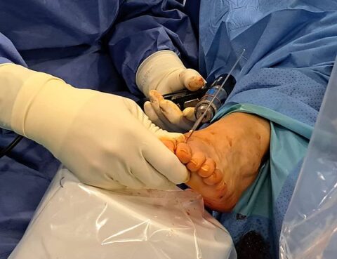 Cirugía Percutánea del Pie (CPP) por el Dr. Mikel Ayerra del Centro Médico Sendagrup de Donostia - San Sebastián