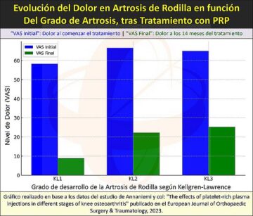 Mejora significativa del dolor tras tratamiento con Plasma Rico en Plaquetas (PRP) en pacientes con artrosis de rodilla, según Annaniemi y col. Divulgación del Centro Médico Sendagrup de Donostia - San Sebastián