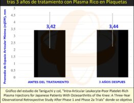 Detención de la degeneración del cartílago en artrosis de rodilla, mediante tratamiento con Plasma Rico en Plaquetas (PRP)
