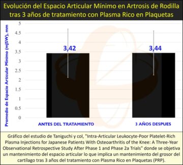 Detención de la degeneración del cartílago en artrosis de rodilla, mediante tratamiento con Plasma Rico en Plaquetas (PRP)